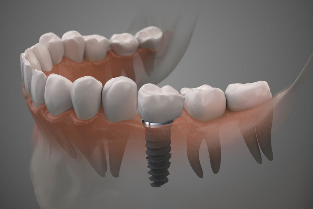 3D rendering of dental implant post in jaw