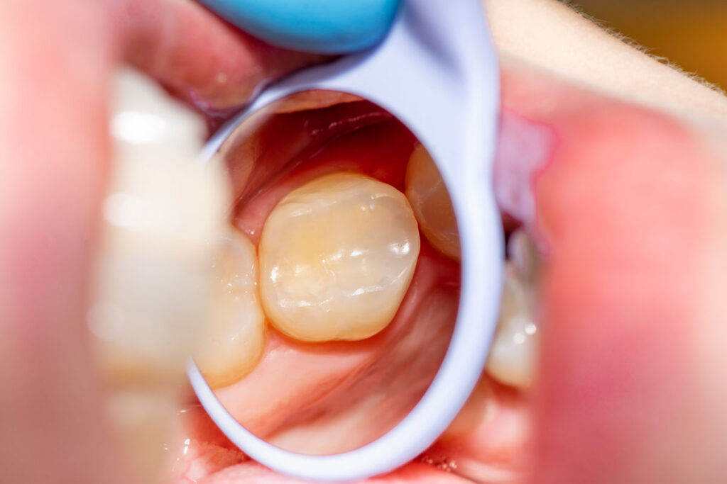 Closeup of a composite filling on tooth