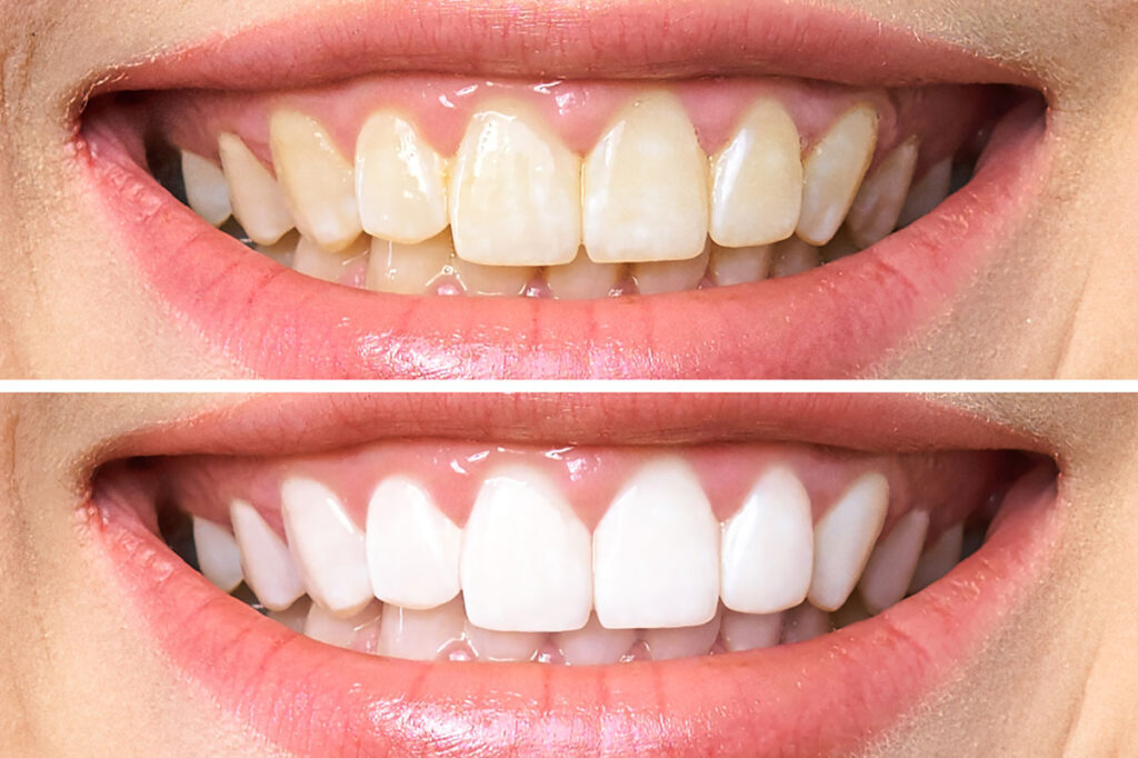 Close-up comparison of teeth before and after professional whitening