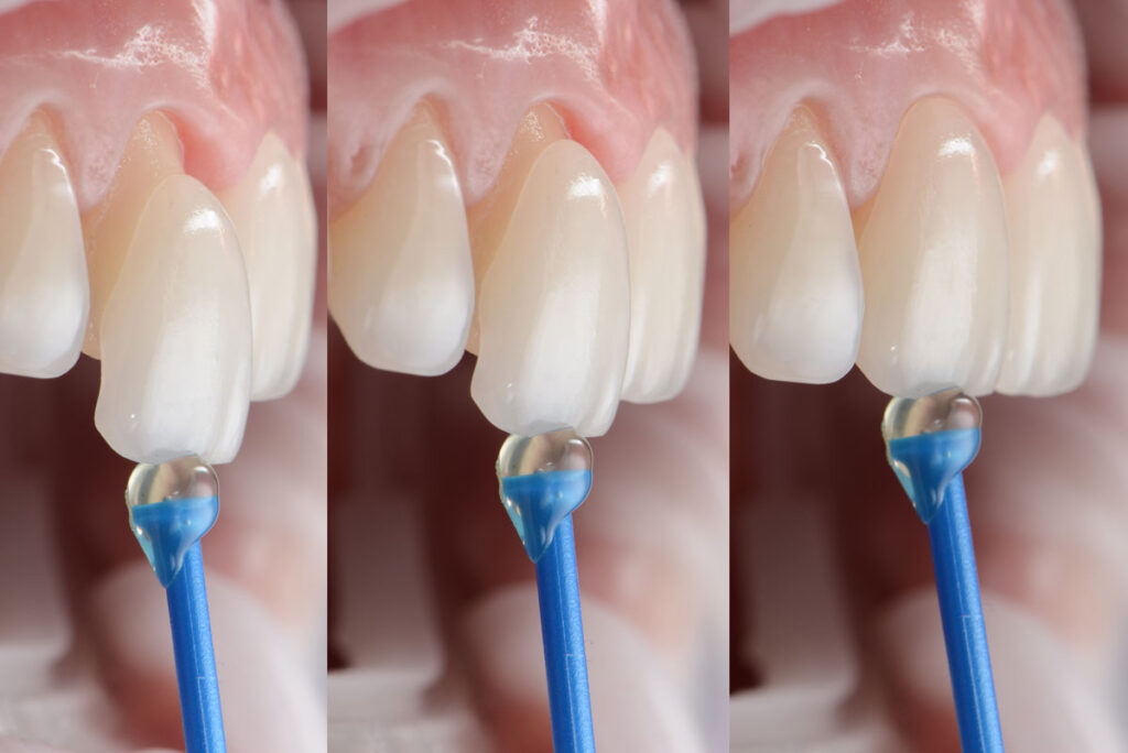 Close-up of dental veneer being bonded to front tooth